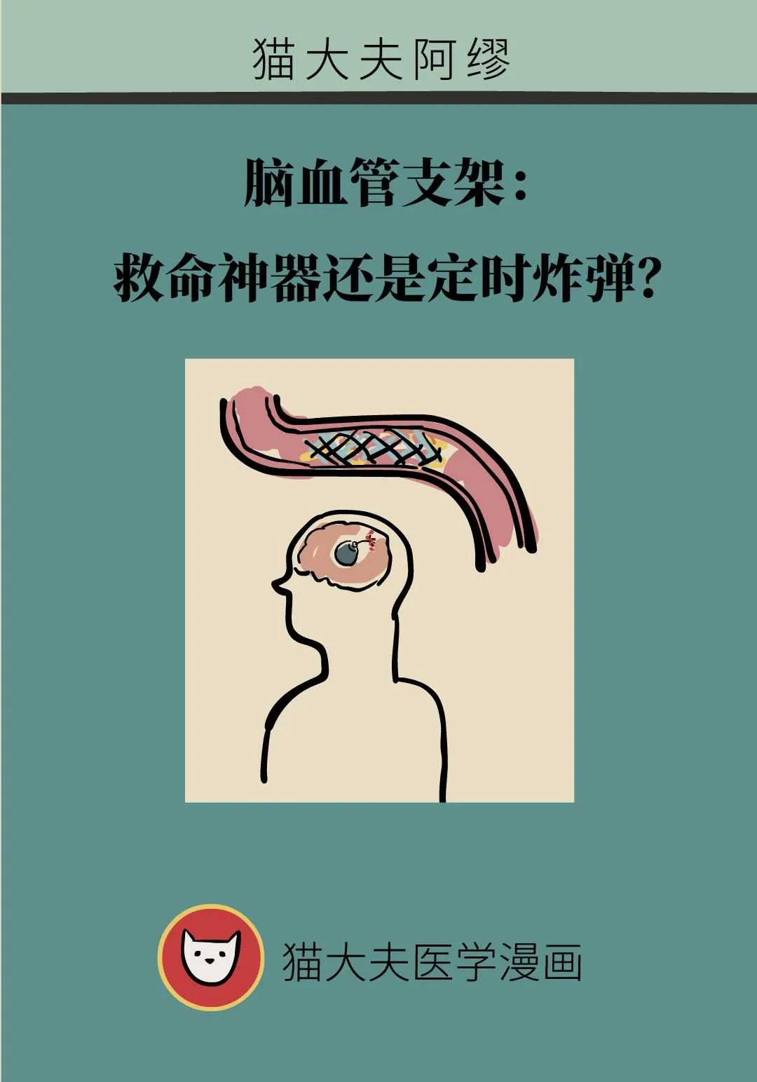 腦血管支架：救命神器還是定時炸彈？聽聽醫生的大實話