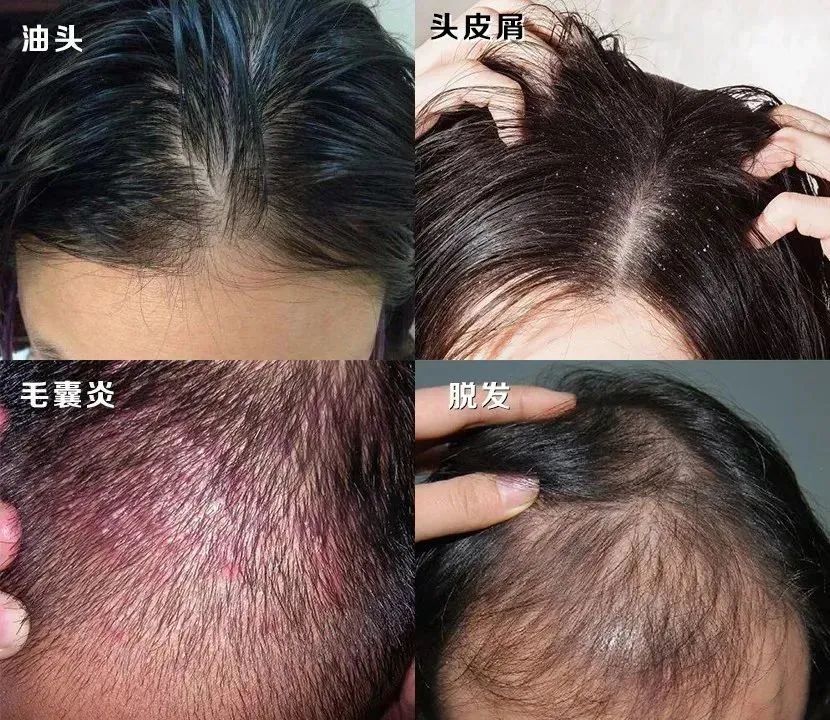 洗頭沒洗這裡？難怪會一直頭油、頭屑、頭癢還掉髮！