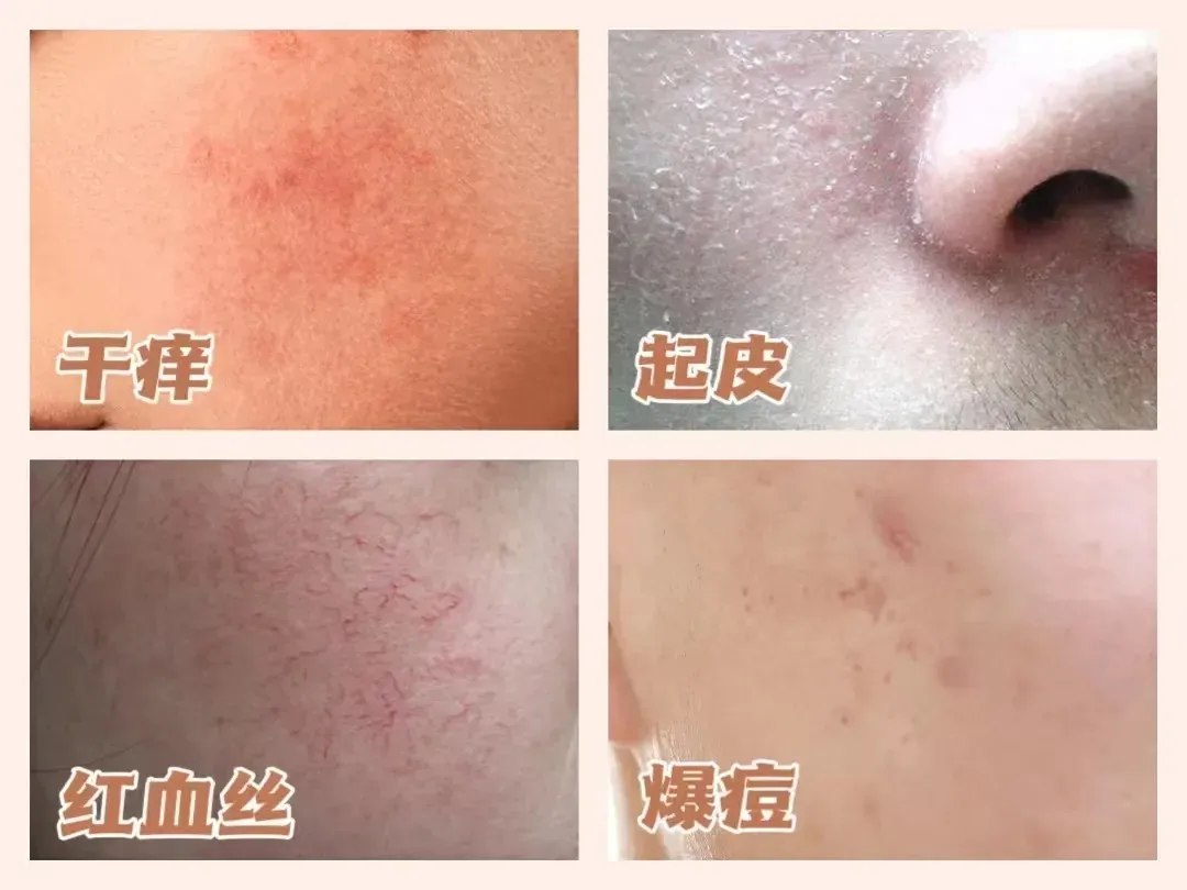 換季泛紅又起皮？噴它3秒“回血”，同事追著問連結！！