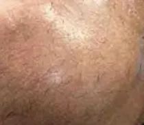 這玩意居然是個瘤？！小哥腫瘤半年長到70斤，比兩腿都粗！拖5年終於切了….