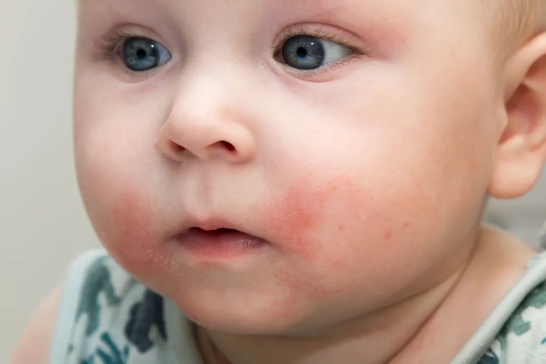 家庭聚餐後，6歲男孩全身水腫，搶救時死亡，男孩媽媽將嫂子告上法庭