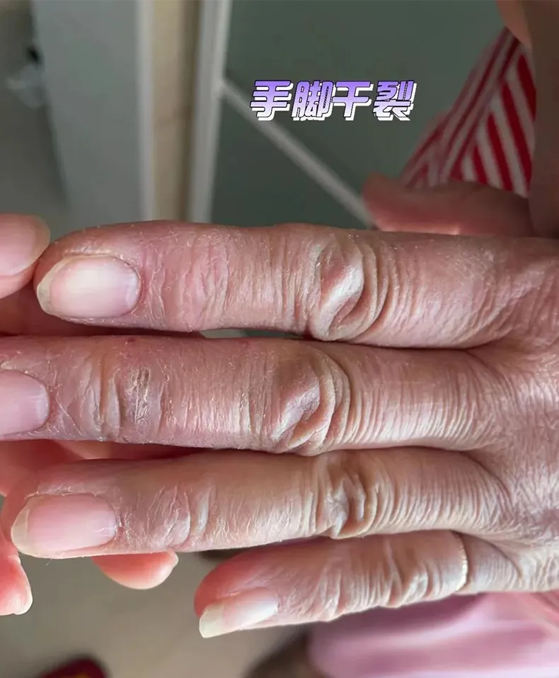 腳後跟粗糙？開裂？滲血？一招嫩回細膩雞蛋白