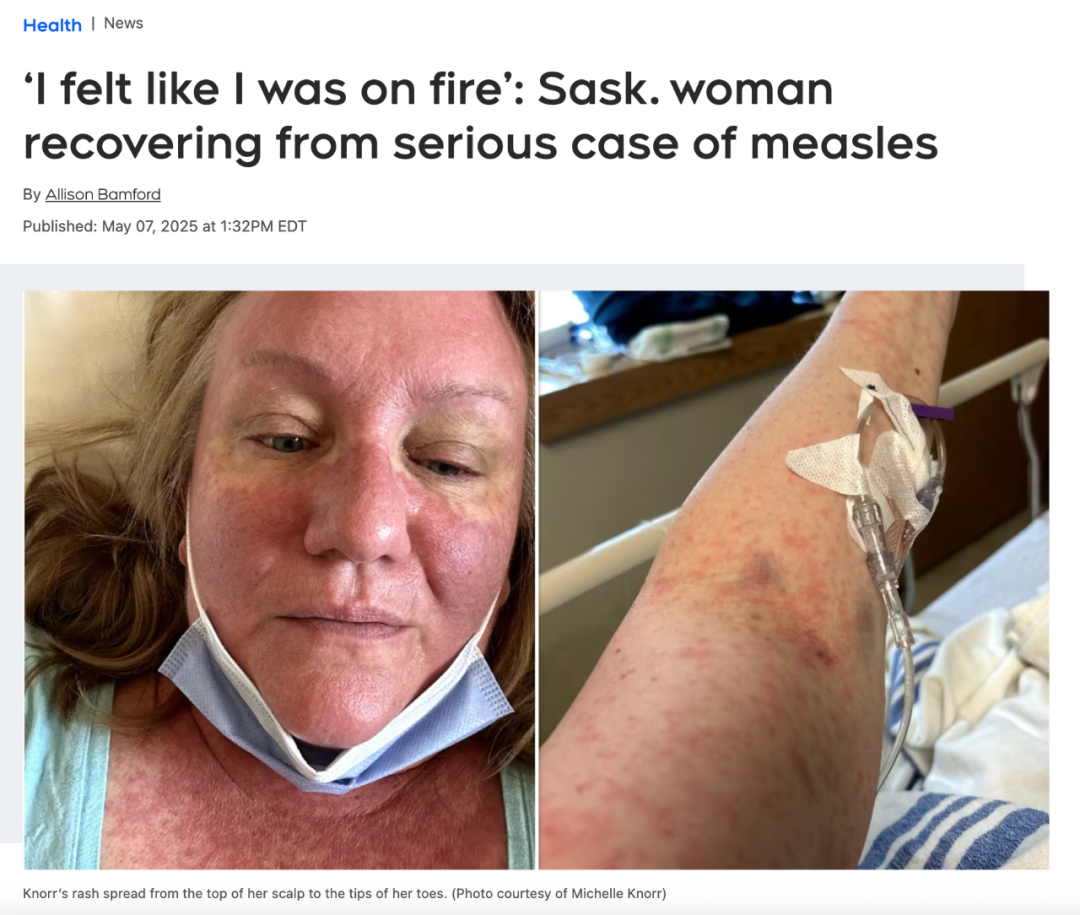 “像渾身被火燒”加拿大女子嚴重麻疹進ICU！全身鮮紅沒好肉，差點去世！還以為是感冒