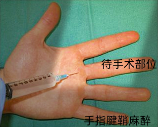 手指腱鞘麻醉具體怎麼操作？