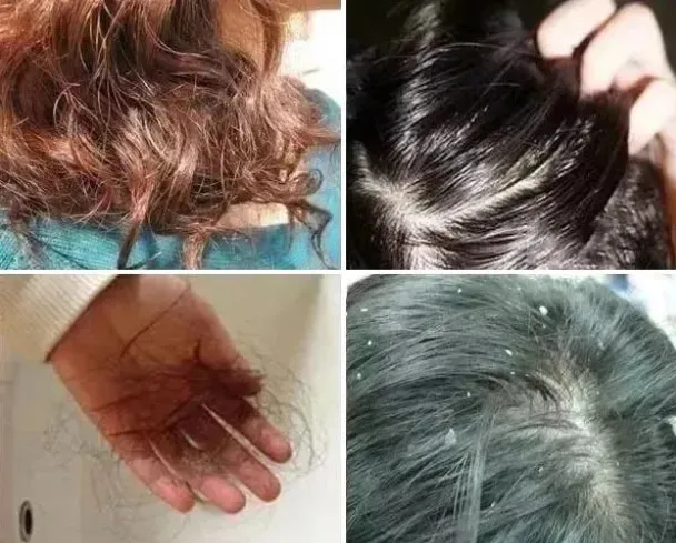 頭皮問題多可怕？90歲康王創始人研發“青蒿”頭皮精華素！頭皮養護天花板、1瓶讓你重建好頭皮！