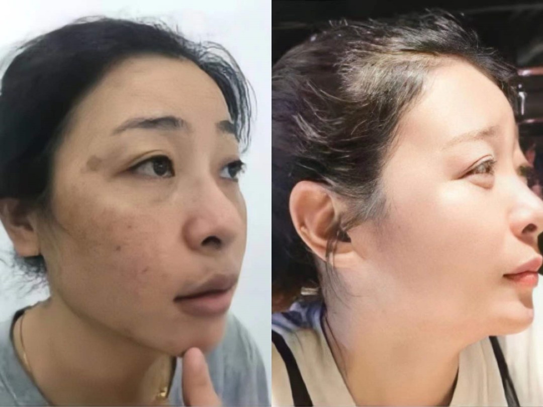 服了！上海40歲女子在家給自己“整容”，遭女兒發文爆錘：到底是什麼讓你這麼瘋狂！