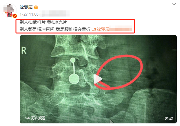 已確診！沈夢辰腰椎斷裂：人活一世太難了….