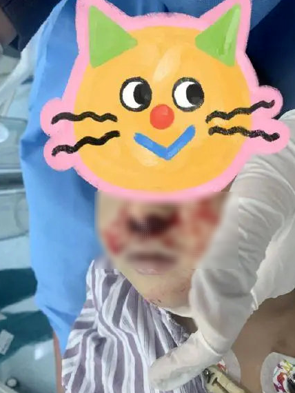 3歲男童休克，雙側鼻腔糜爛，血流不止！醫生一問，竟是奶奶把頭髮塞娃鼻腔……