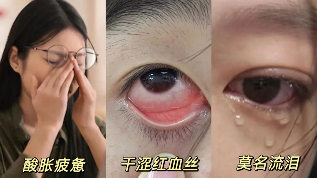 眼睛癢！幹！分泌物多……看過來！首次體驗，驚呆了！5秒舒爽！