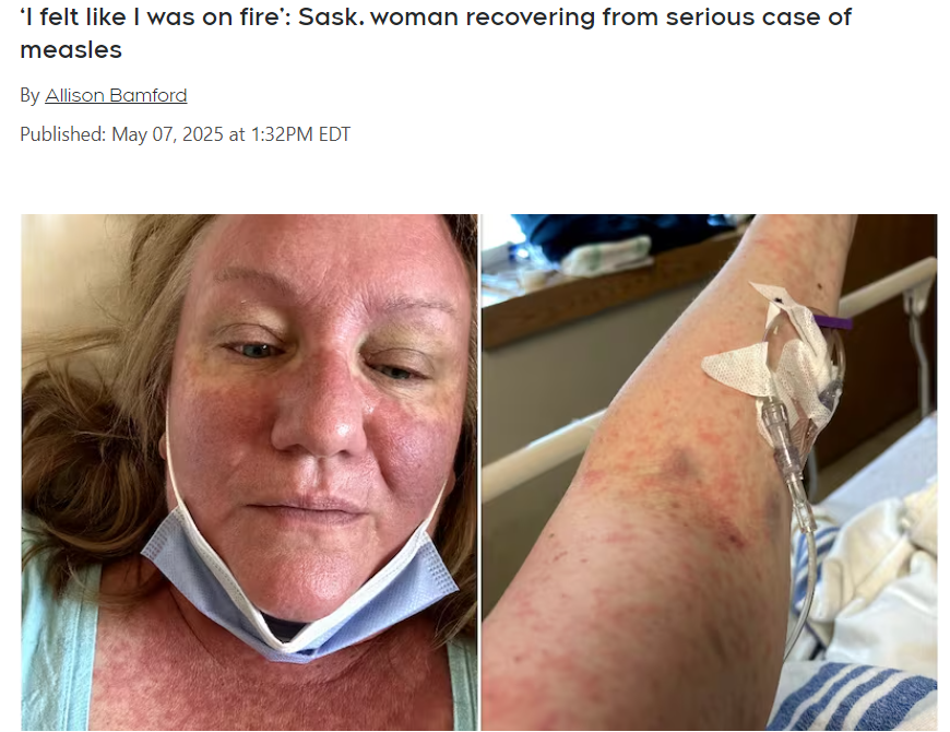 “我覺得自己像著火了一樣！”加拿大女子全身長滿紅斑，差點沒挺過去！竟是因為感染了….