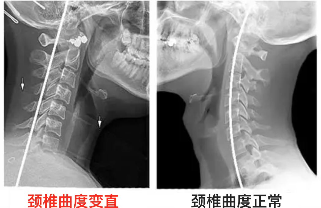 這個看似舒服的睡姿，加重頸椎負擔還可能造成雙下巴